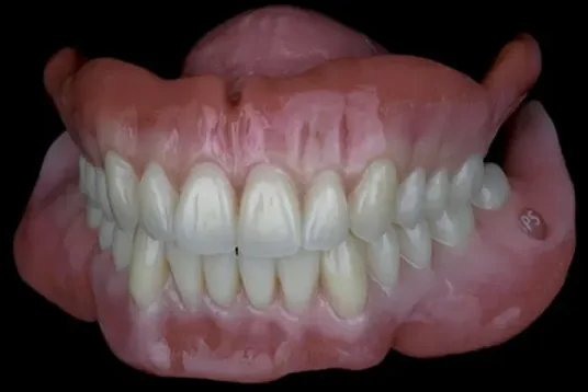 A precision denture with lifelike nano-ceramic teeth from Miller Dental Care in Orillia